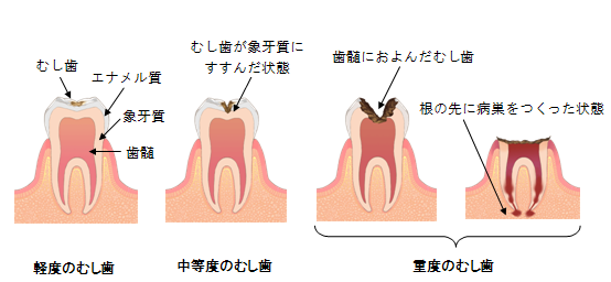 虫歯の進行度