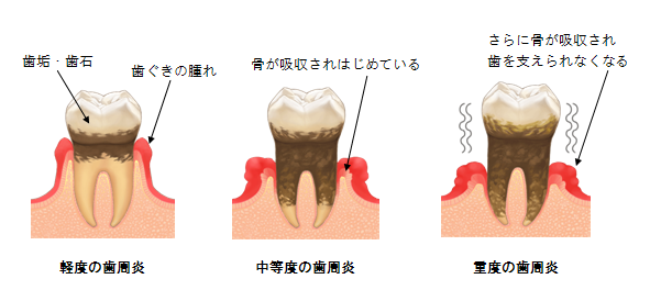 歯周炎の進行度